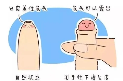 哪种割包皮手术创伤小